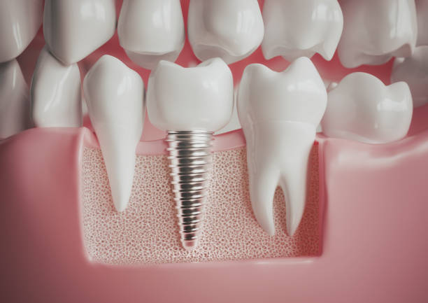 Dental implants